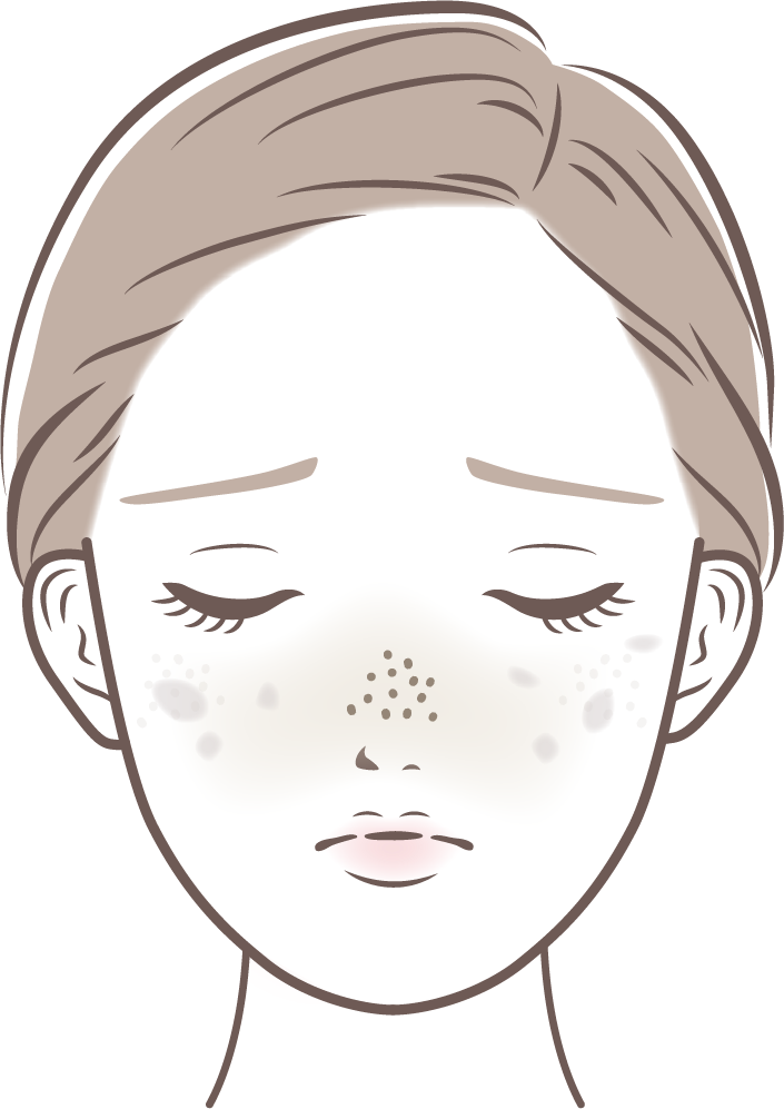 Qスイッチルビーレーザー