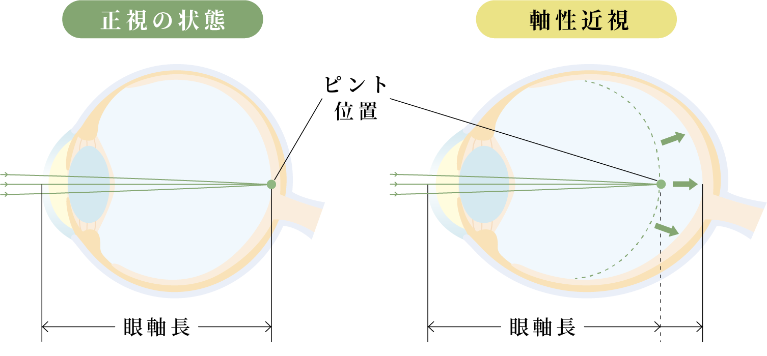 近視の進行について