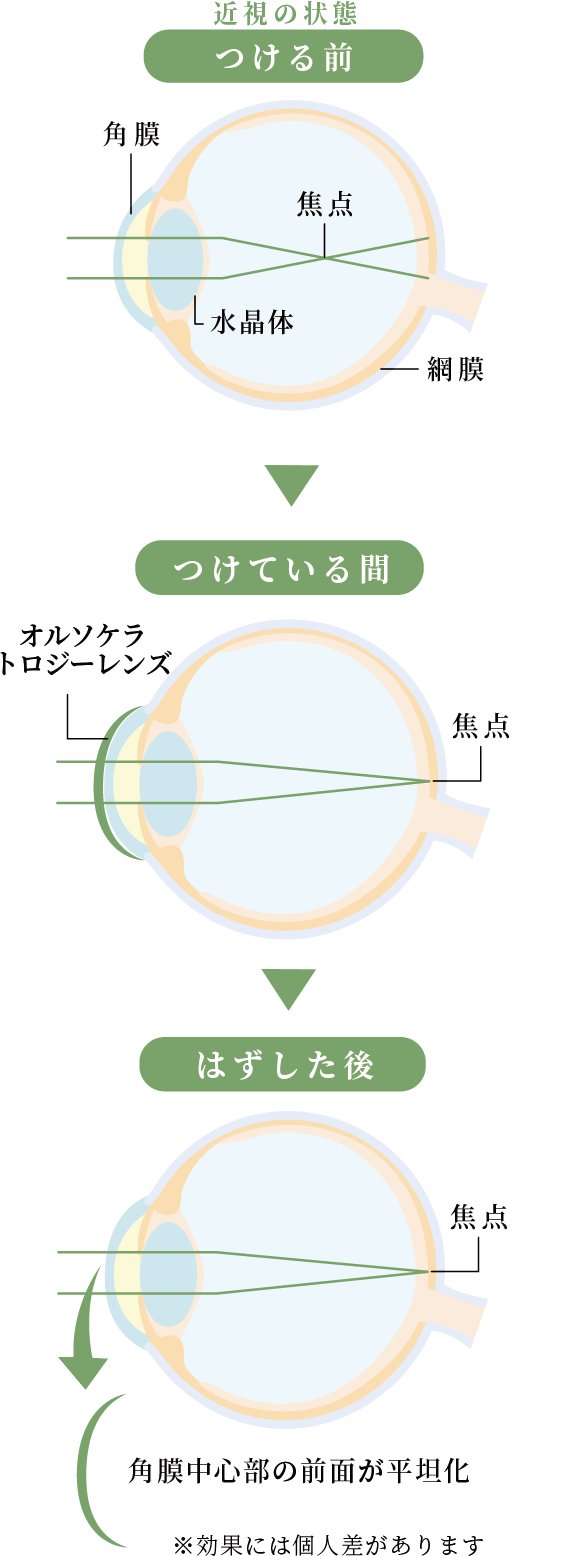 オルソケラトロジーレンズの仕組み